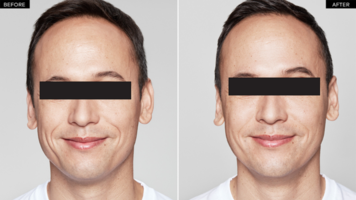 Restylane Fill_before after