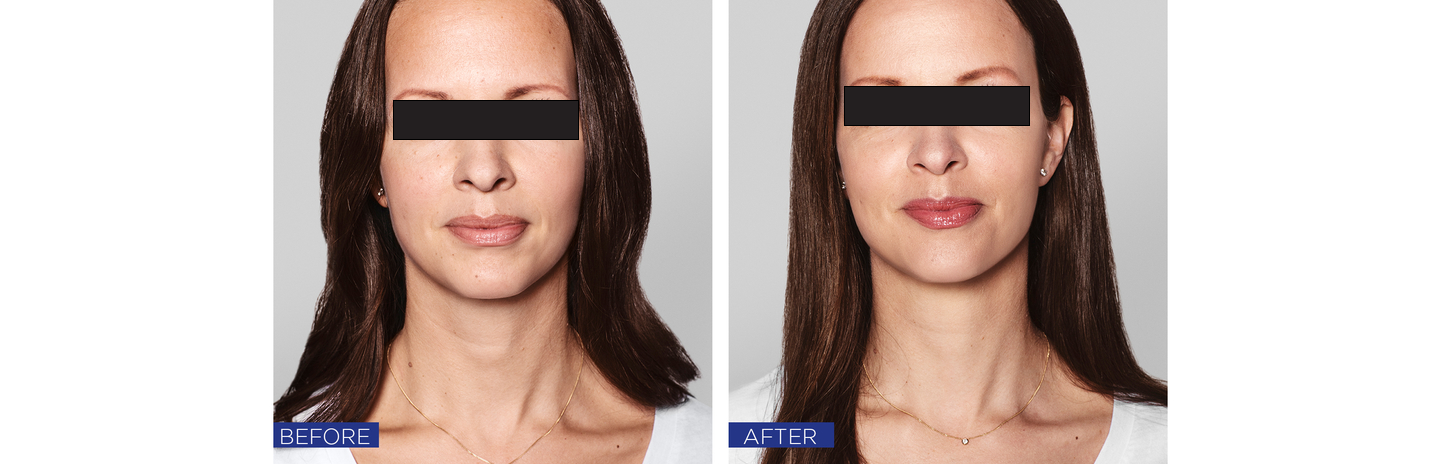 Skinboosters Before After