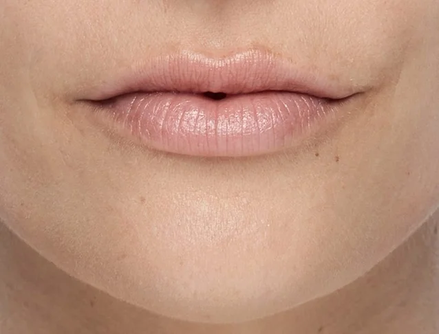 consumer_v3_restylane_lips