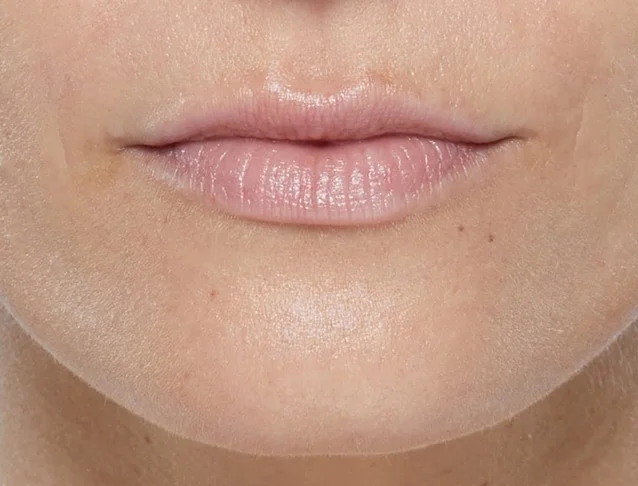 consumer_v3_restylane_lips