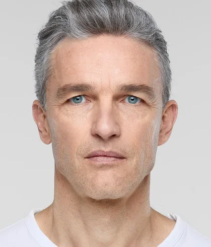 sculptra_ba_loic_after-6-months