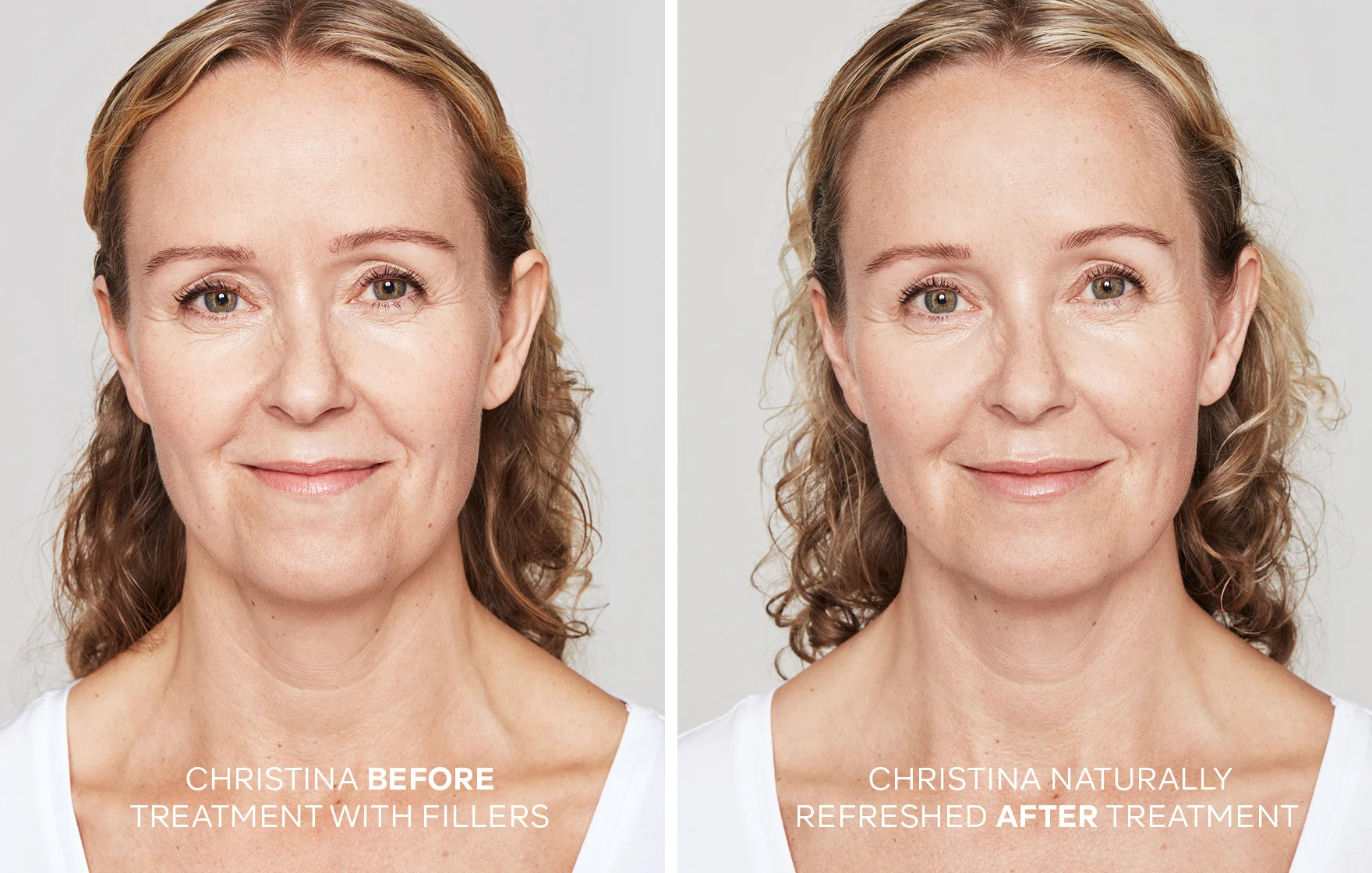 How long do fillers last or are they permanent?