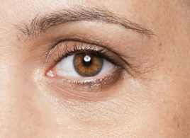 dark_circles_under_eyes