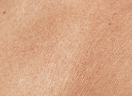 dry_skin