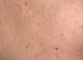 pigmentation