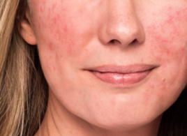 skin_redness